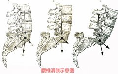 武汉腰椎滑脱的非手术治疗方法有哪些