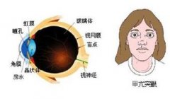 重庆骑士医院：“借我一双慧眼”—甲状腺相关性眼病的护理小妙招