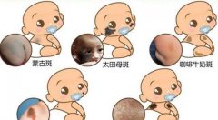宝宝身上可能出现的胎记有哪些？