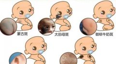 宝宝身上可能出现的胎记有哪些?